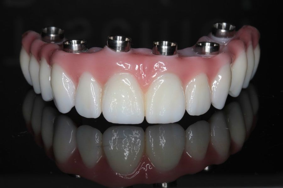 Dental Implants Without Pain-nobel